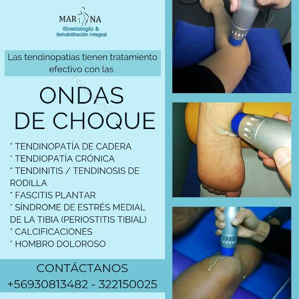 tratamiento espolon calcaneo con ondas de choque